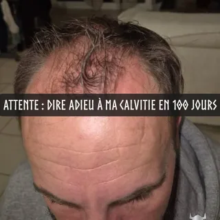 Expectation :
“Ça va repousser tout seul.”

Réalité :
Les golfes n’attendent pas.

Expectation :
“30 jours ça suffit.”

Réalité :
Le cycle capillaire est lent. Très lent.

Expectation :
“C’est juste l