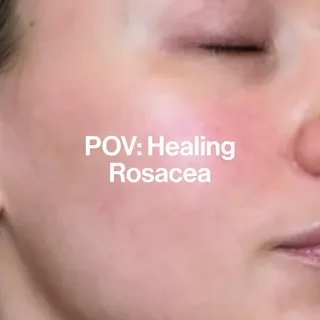 Marlene hat an Rosacea gelitten, doch was ist das eigentlich? 🧴

Rosacea ist eine chronisch-entzündliche Hauterkrankung, die meist im Gesicht auftritt: besonders an Wangen, Nase, Stirn oder Kinn. Typi
