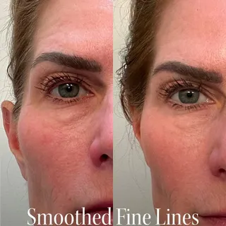 726,000+ trust the power of light.
Real results you see in the mirror.
FDA-cleared Red Light Therapy that helps support collagen for visibly firmer, smoother, younger-looking skin.