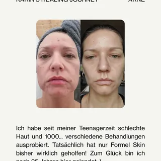 Karin hatte lange mit Akne zu kämpfen. Heute dürfen wir ihre Hautgeschichte mit euch teilen.

„Ich habe seit meiner Teenagerzeit schlechte Haut und 1000… verschiedene Behandlungen ausprobiert. Tatsäch